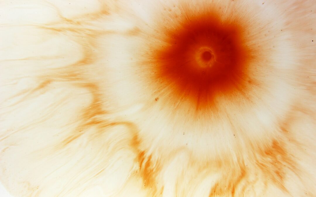 ”Vilket vackert sår…” – Syfilis i kropp och samhälle